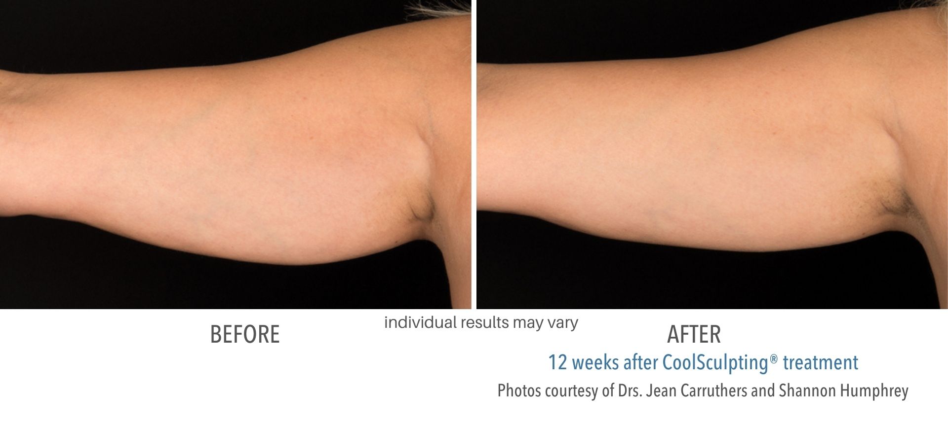 coolsculpting treatment upper arm fat area provided by Skin Suite RX.