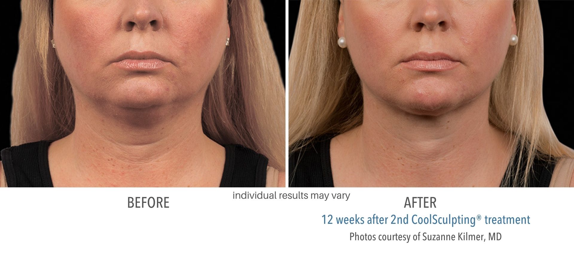 Coolsculpting treatment double chin before and after results provided by Skin Suite RX.