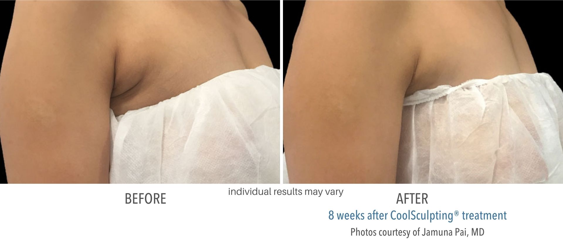 Coolsculpting treatment armpit fat before & after provided by Skin Suite RX.