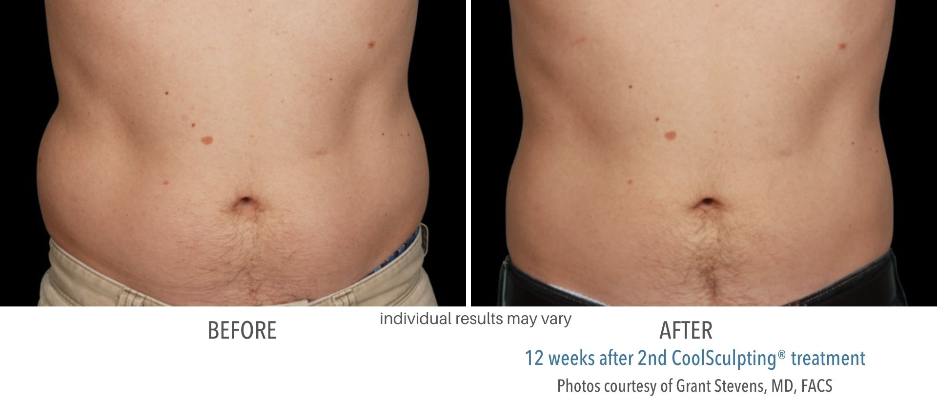 Coolsculpting treatment abdomen for men before and after treatment at Skin Suite RX.