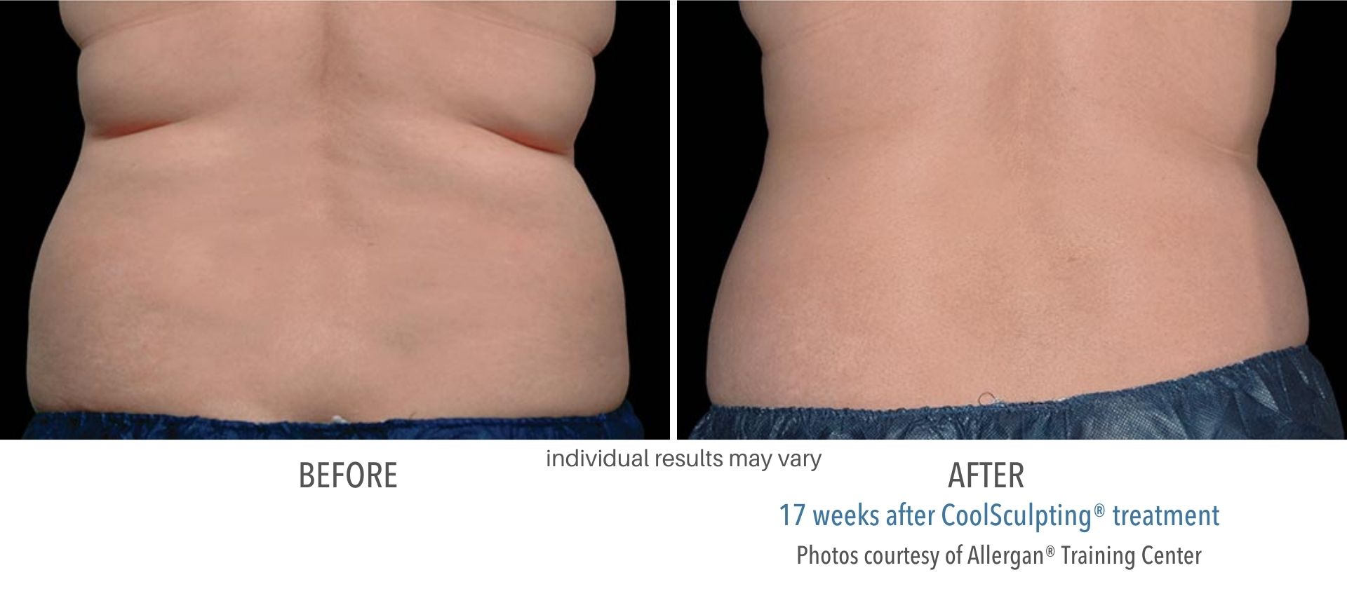 Coolsculpting before and after treatment at skin suite RX.