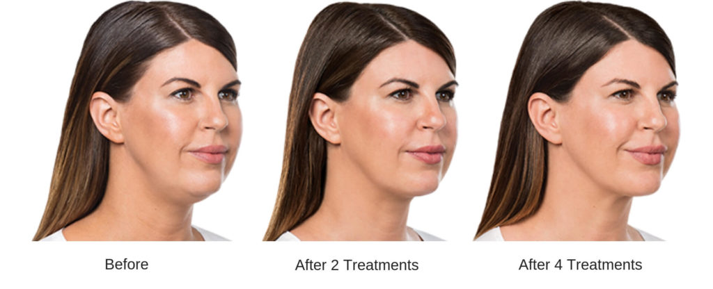 Woman's before and after Kybella at Skin Suite RX.