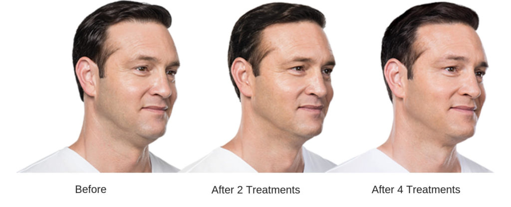 Man's before and after Kybella at Skin Suite RX.