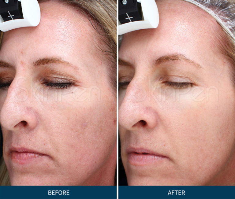 What Is Microneedling Treatment? Skin Suite RX Medspa in California